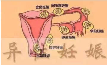 異位妊娠預(yù)防知識(shí)