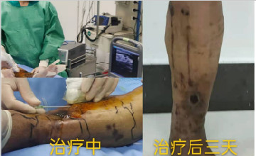 臨沂市第三人民醫(yī)院成功實(shí)施首例下肢靜脈曲張微波閉合治療術(shù)